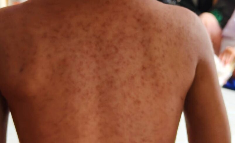 CDMX informa sobre alcaldías con más casos de sarampión y llama a no “estigmatizar”